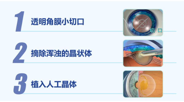 白內(nèi)障手術